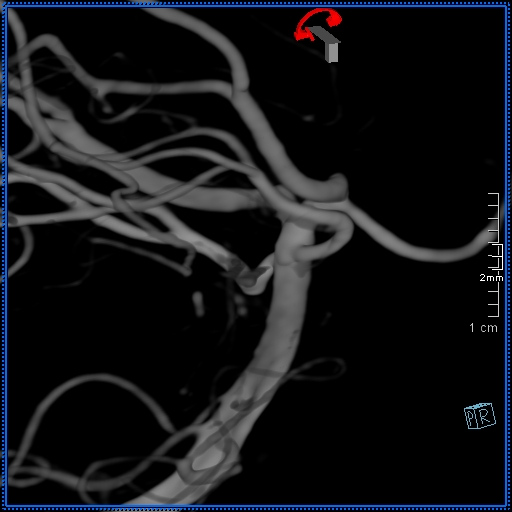 Basilar artery perforator aneurysm (Radiopaedia 82455-99524 3D Left VA 72).jpg