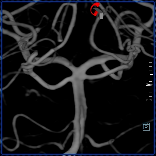 Basilar artery perforator aneurysm (Radiopaedia 82455-99524 3D Left VA 88).jpg