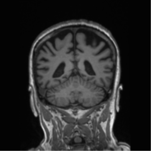 File:Behavioral variant frontotemporal dementia and late onset schizophrenia (Radiopaedia 52197-58083 Coronal T1 34).png