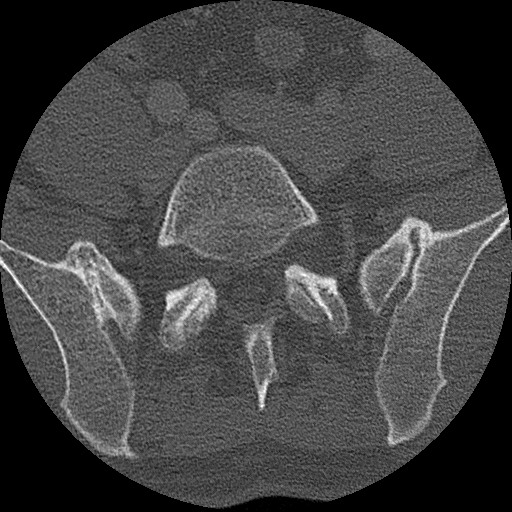 Benign post-traumatic pseudopneumoperitoneum (Radiopaedia 71199-81495 Axial bone window 279).jpg