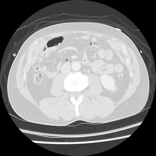 Benign post-traumatic pseudopneumoperitoneum (Radiopaedia 71199-81495 Axial lung window 91).jpg