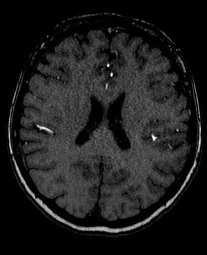 Berry aneurysm of the terminal internal carotid artery (Radiopaedia 88286-104918 Axial TOF 149).jpg