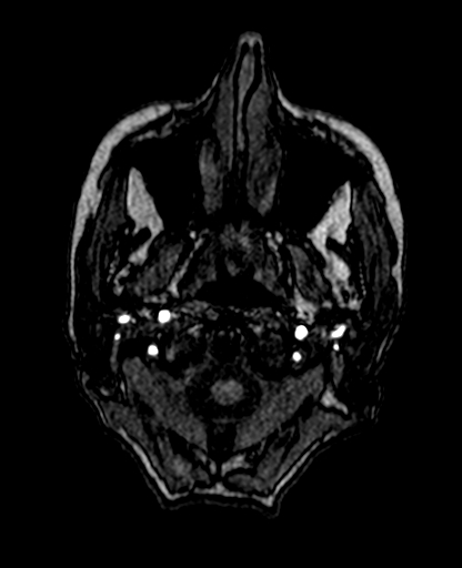 Berry aneurysm of the terminal internal carotid artery (Radiopaedia 88286-104918 Axial TOF 22).jpg