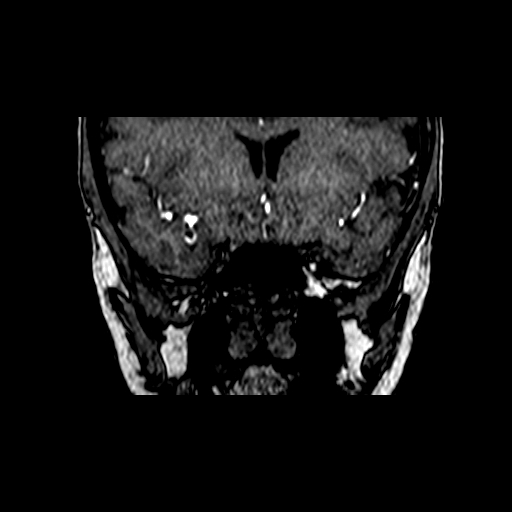 File:Berry aneurysm of the terminal internal carotid artery (Radiopaedia 88286-104918 Coronal TOF 25).jpg