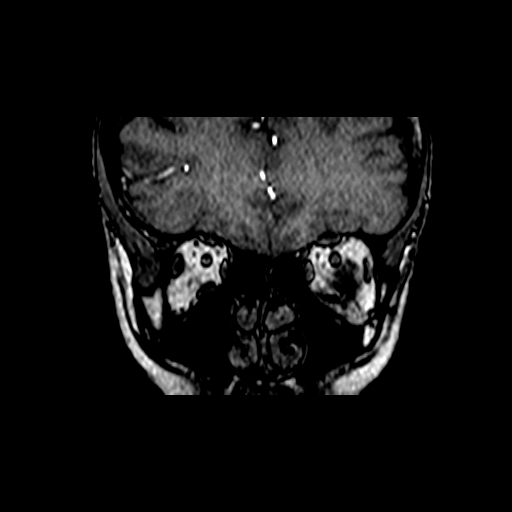 Berry aneurysm of the terminal internal carotid artery (Radiopaedia 88286-104918 Coronal TOF 7).jpg