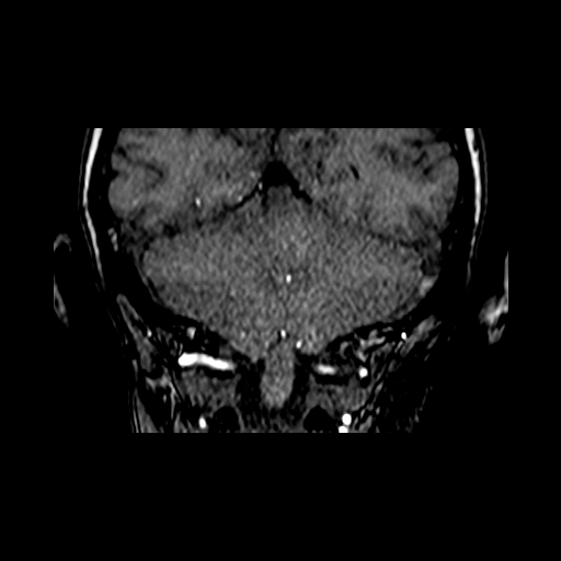 File:Berry aneurysm of the terminal internal carotid artery (Radiopaedia 88286-104918 Coronal TOF 88).jpg