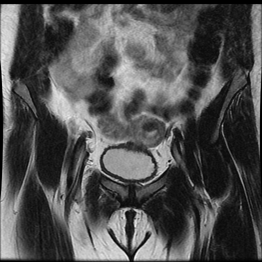 File:Bicornuate uterus (Radiopaedia 51676-57472 Coronal T2 8).jpg