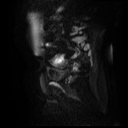 File:Bicornuate uterus (Radiopaedia 51676-57472 Sagittal DWI 35).jpg