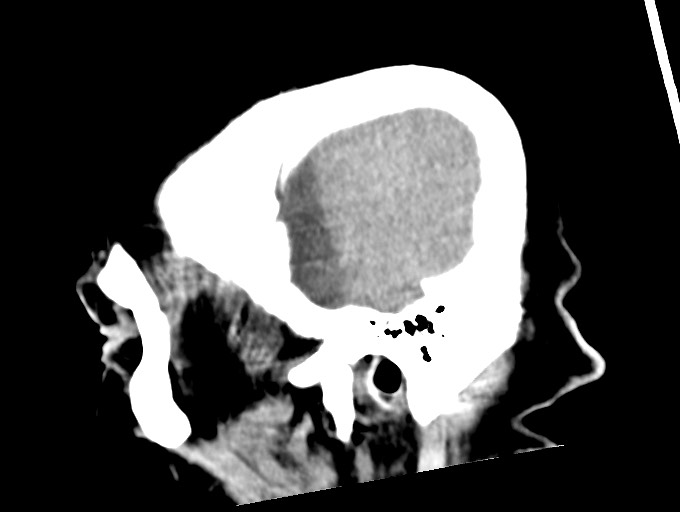 Bilateral acute on chronic subdural hematomas (Radiopaedia 78466-91146 C 49).jpg