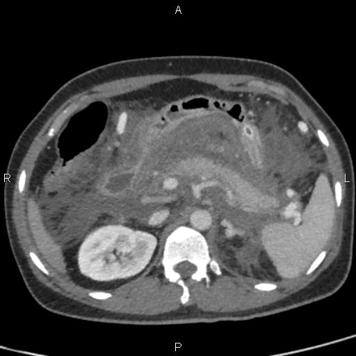 Bilateral adrenal gland hyperenhancement in pancreatitis (Radiopaedia 86642-102753 E 32).jpg