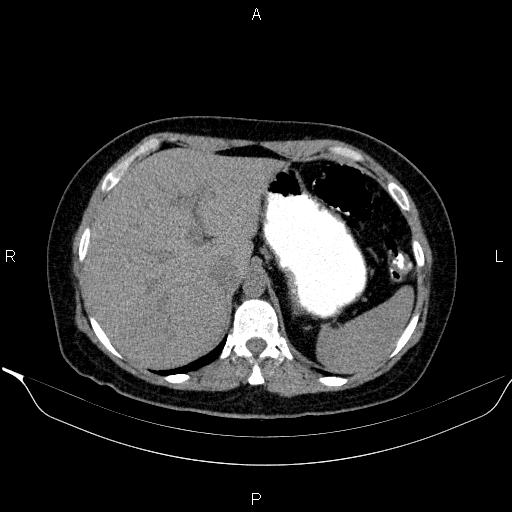 Bilateral adrenal myelolipoma (Radiopaedia 63058-71535 Axial non-contrast 34).jpg