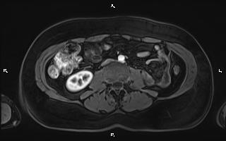 Bilateral adrenal myelolipoma (Radiopaedia 63058-71537 Axial T1 C+ fat sat 63).jpg