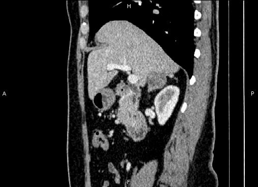 Bilateral benign adrenal adenomas (Radiopaedia 86912-103124 E 37).jpg