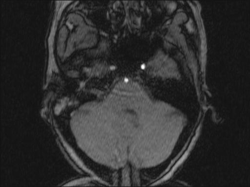 Bilateral carotid body tumors and right glomus jugulare tumor (Radiopaedia 20024-20060 Axial MRA 319).jpg