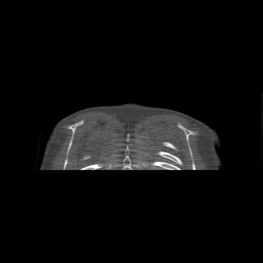 File:Bilateral chronic posterior shoulder dislocation (Radiopaedia 39213-41452 Coronal bone window 60).jpg