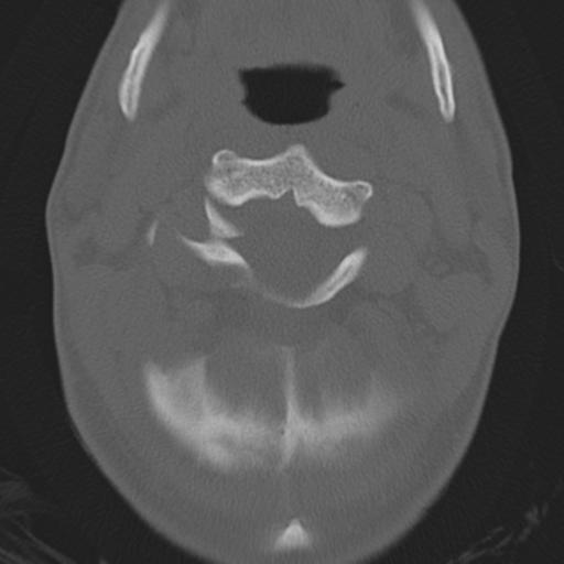 File:Bilateral locked facets (Radiopaedia 33850-35016 Axial bone window 10).png