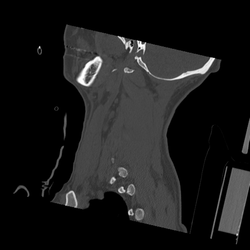 Bilateral locked facets (Radiopaedia 33850-35023 Sagittal bone window 9).png