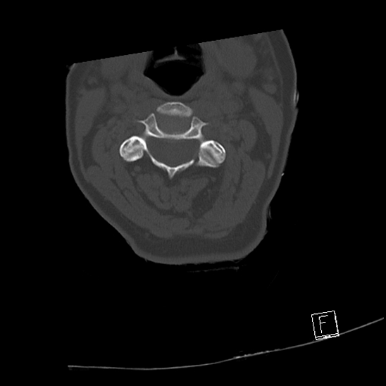 Bilateral occipital condyle fractures (type 3) (Radiopaedia 87672-104086 Axial bone window 30).jpg