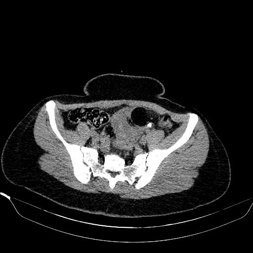File:Bilateral ovarian dermoid (Radiopaedia 45714-49907 Axial non-contrast 15).JPEG