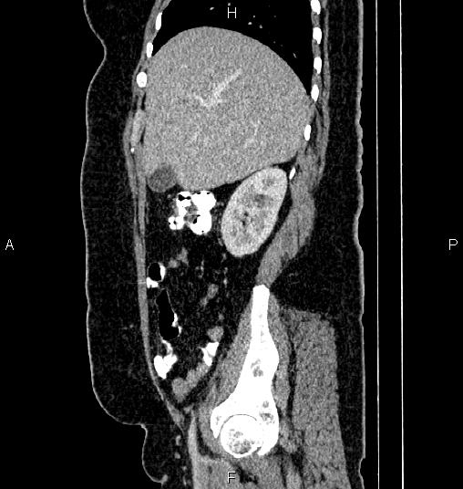 Bilateral ovarian dermoid cysts (Radiopaedia 85785-101603 D 20).jpg