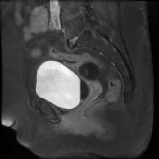 File:Bilateral ovarian dermoid cysts (Radiopaedia 90152-107338 Sagittal T1 C+ 11).jpg