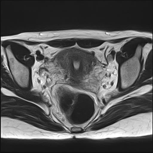 File:Bilateral ovarian endometriomas (Radiopaedia 87085-103347 Axial T2 12).jpg