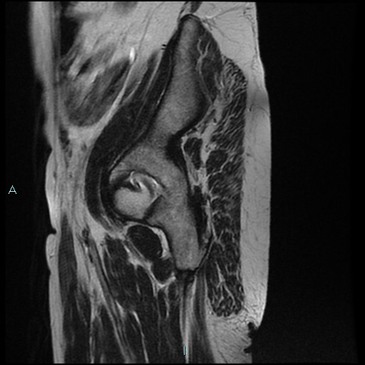 File:Bilateral ovarian fibroma (Radiopaedia 44568-48293 Sagittal T2 33).jpg