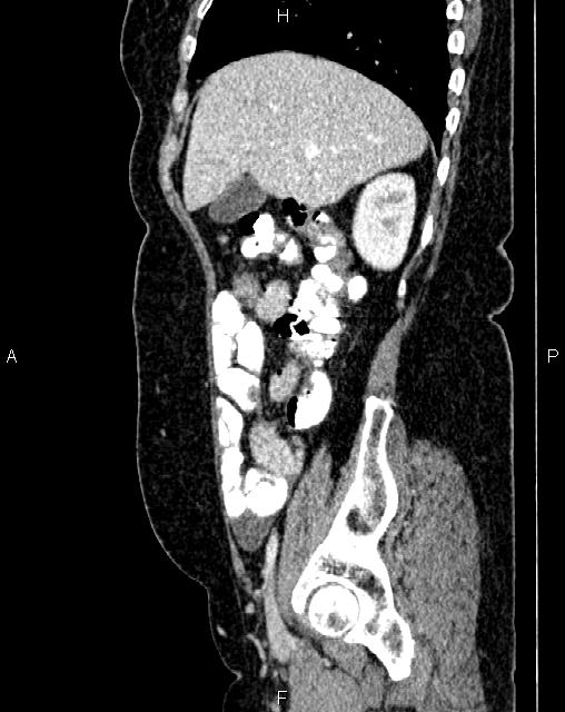 Bilateral ovarian serous cystadenocarcinoma (Radiopaedia 86062-101989 E 18).jpg