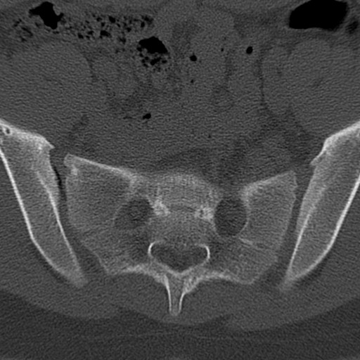 Bilateral pars defect (Radiopaedia 26691-26846 Axial bone window 95).jpg