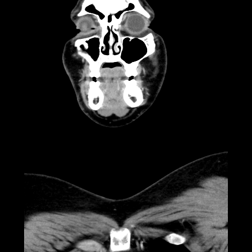 File:Bilateral peritonsillar abscess (Radiopaedia 85065-100610 Coronal 16).jpg