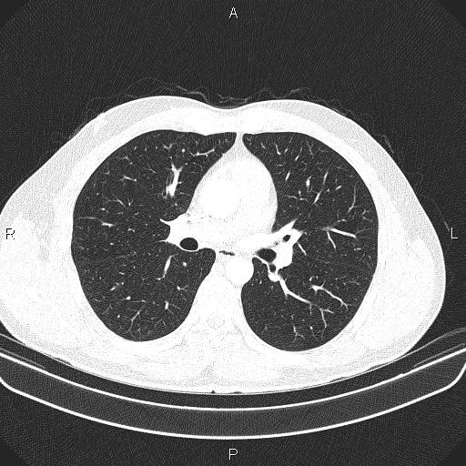 File:Bilateral pulmonary AVM (Radiopaedia 83134-97505 Axial lung window 35).jpg