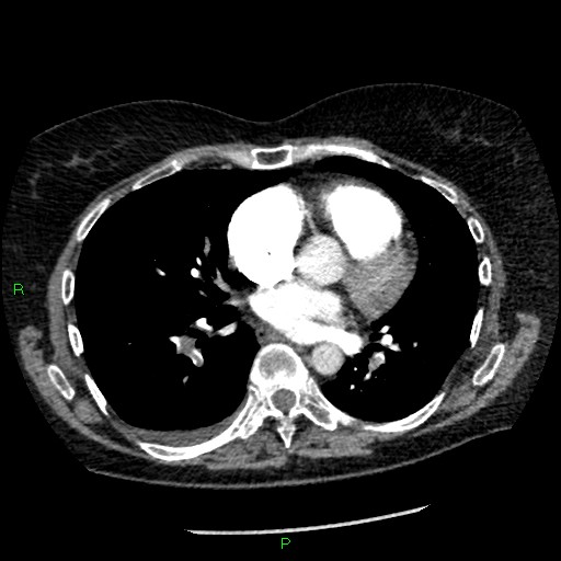 Bilateral pulmonary emboli (Radiopaedia 32700-33669 Axial C+ CTPA 62).jpg