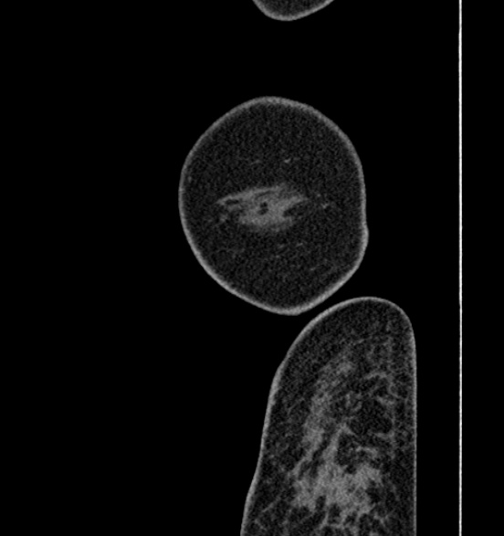 File:Bilateral rectus sheath hematomas (Radiopaedia 50778-56252 B 1).jpg