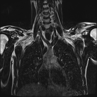 File:Bilateral spinoglenoid notch ganglion cysts (Radiopaedia 29577-30082 Coronal T2 47).jpg