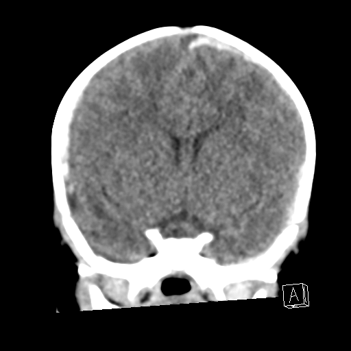 File:Bilateral subdural hemorrhage and parietal skull fracture (Radiopaedia 26058-26192 Coronal non-contrast 11).png