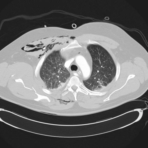 Bilateral traumatic renovascular injury (Radiopaedia 32051-32995 Axial lung window 16).jpg