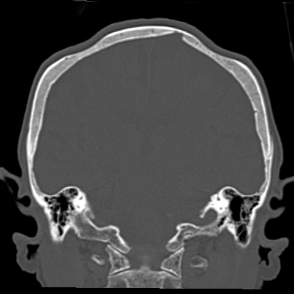 Biparietal osteodystrophy (Radiopaedia 46109-50463 Coronal bone window 65).jpg