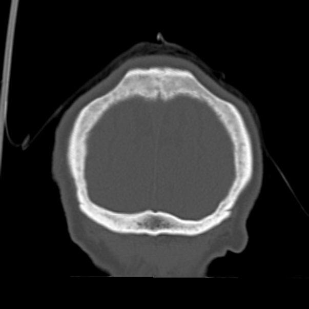 Biparietal osteodystrophy (Radiopaedia 46109-50463 Coronal bone window 96).jpg