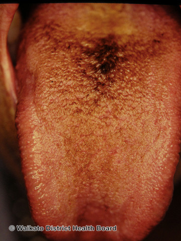 File:Black hairy tongue (DermNet NZ reactions-w-black-tongue02).jpg