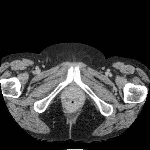 Bladder tumor detected on trauma CT (Radiopaedia 51809-57609 C 147).jpg