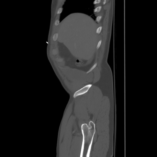 Blunt abdominal trauma with solid organ and musculoskelatal injury with active extravasation (Radiopaedia 68364-77895 Sagittal bone window 4).jpg