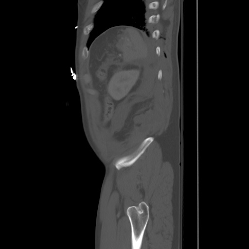 Blunt abdominal trauma with solid organ and musculoskelatal injury with active extravasation (Radiopaedia 68364-77895 Sagittal bone window 96).jpg