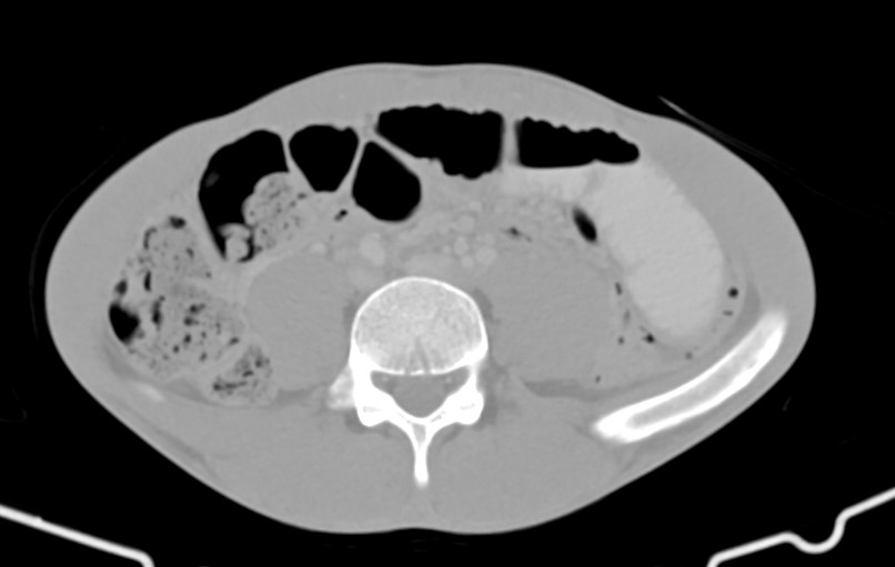Blunt injury to the small bowel (Radiopaedia 74953-85987 Axial Wide 60).jpg