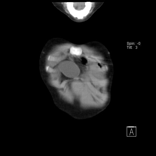 File:Bochdalek diaphragmatic hernia (Radiopaedia 38866-41059 Coronal liver window 1).jpg