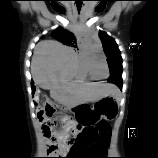 File:Bochdalek diaphragmatic hernia (Radiopaedia 38866-41059 Coronal liver window 8).jpg