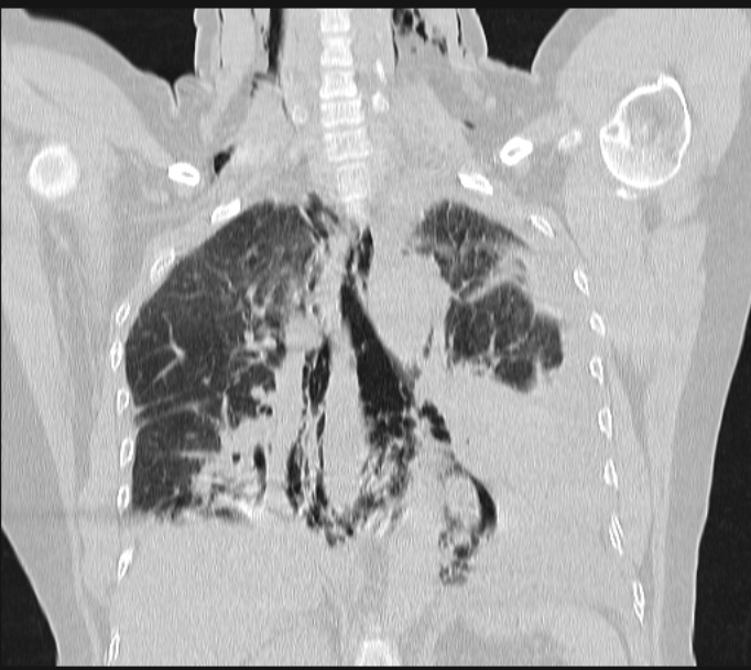 Boerhaave syndrome (Radiopaedia 45644-49799 Coronal lung window 43).jpg