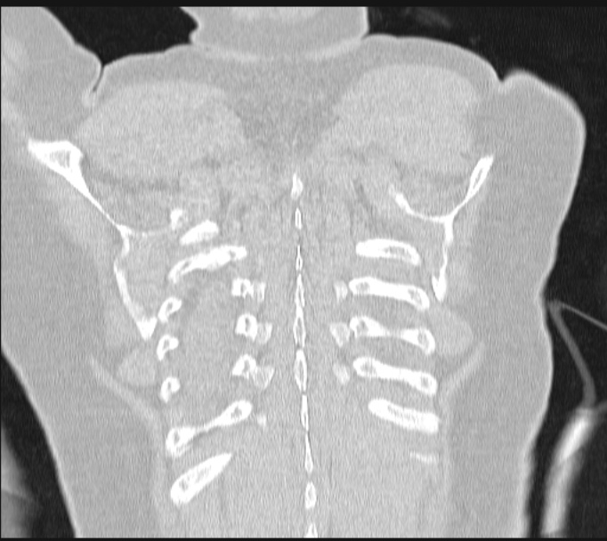 Boerhaave syndrome (Radiopaedia 45644-49799 Coronal lung window 64).jpg