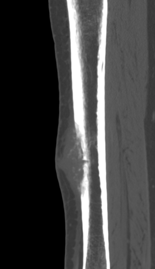 Bone metastasis - tibia (Radiopaedia 57665-64609 Sagittal bone window 82).jpg