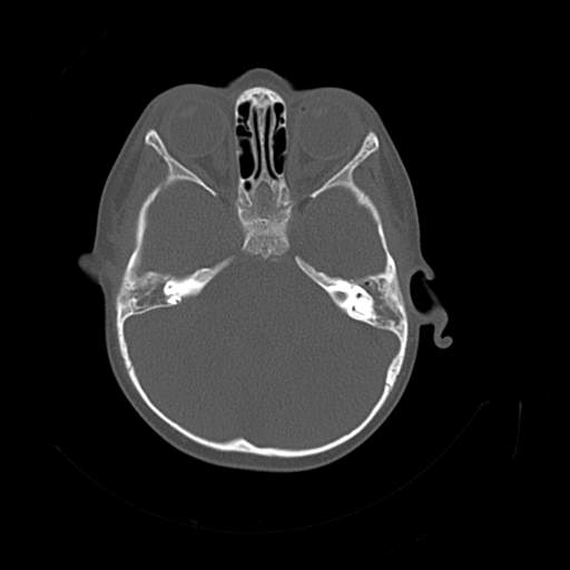 File:Bony atresia of the right external auditory canal (Radiopaedia 27916-28156 Axial bone window 9).jpg