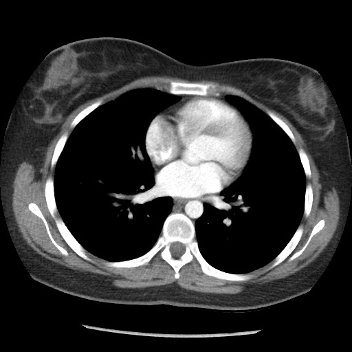 File:Borderline mucinous tumor (ovary) (Radiopaedia 78228-90808 A 27).jpg